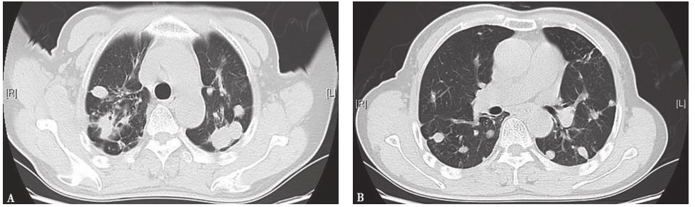 图8 抗结核治疗1年后胸部CT表现-480a88d7898b447993964d05eb435341.jpg